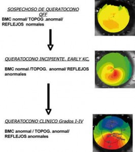 topografias queratocono
