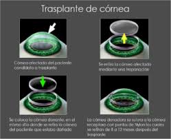 trasplante de cornea