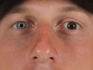 OJOS DE DIFERENTE COLOR