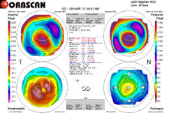topografo-qeratocono