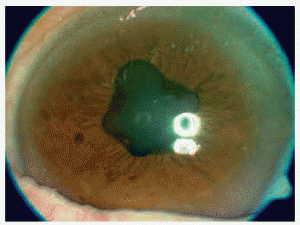 uveitis anterior