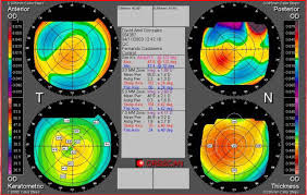 Topografia corneal