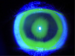 lentes de contacto esclerales