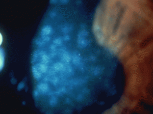 infiltrados corneales