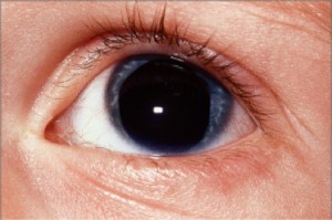 aniridia