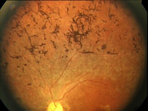 f.o retinosis pigm