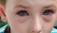 conjuntivitis