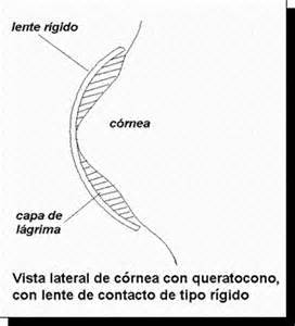 lente RPG queratocono