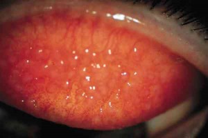 conjuntivitis papilar gigante
