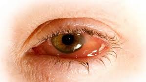 conjuntivitis