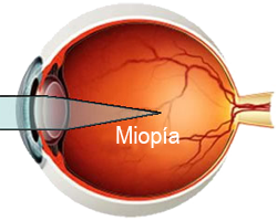 miopia
