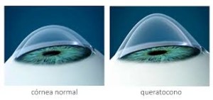 queratocono