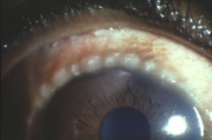 Papilas limbares con manchas de Horner-Trantas