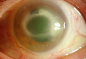 Queratitis por Acanthamoeba con infiltrado anular