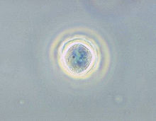 Quiste de Acanthamoeba