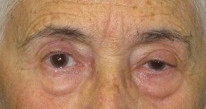 ptosis