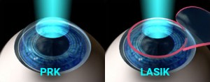 PRK-vs-LASIK