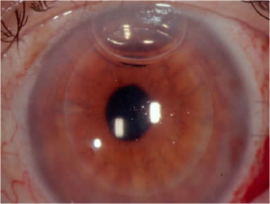 Cornea transplant DSAEK