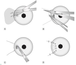 Flap conjuntival de avance