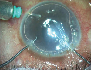 Descemetorhexis bajo aire. Fuente: Healio