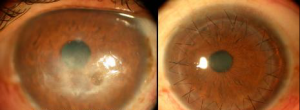 Fuente: cornealclinic.com