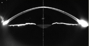 Imagen segmento anterior Scheimpflug. Fuente: ResearchGate
