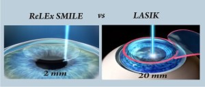 Qvision Superficie ocular en ReLEx SMILE versus femto-LASIK: un meta-análisis Relex vs lasik