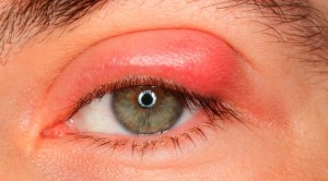 chalazion