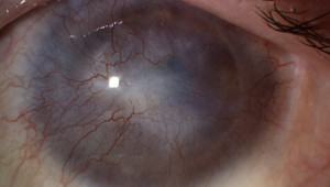 sindrome-de-insuficiencia-limbica