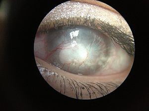 Neovascularizacion corneal