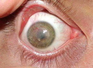 Neovascularización corneal 2
