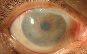 edema corneal