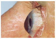 Qvision Congreso de Queratocono apex