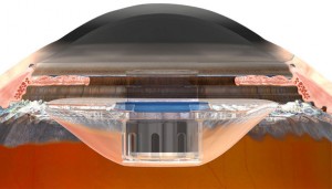 Qvision La FDA aprueba el primer telescopio implantable para el tratamiento de la DMAE severa. ts ocular