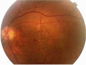 Qvision Papel de la radiación ultavioleta (UV) en la DMAE dmae