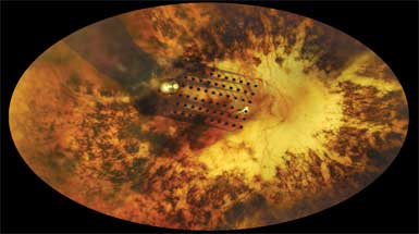 retina ag