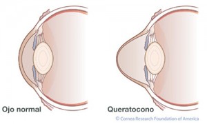 ojo-queratocono1