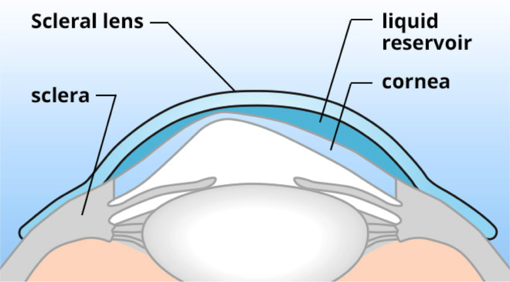 scleral