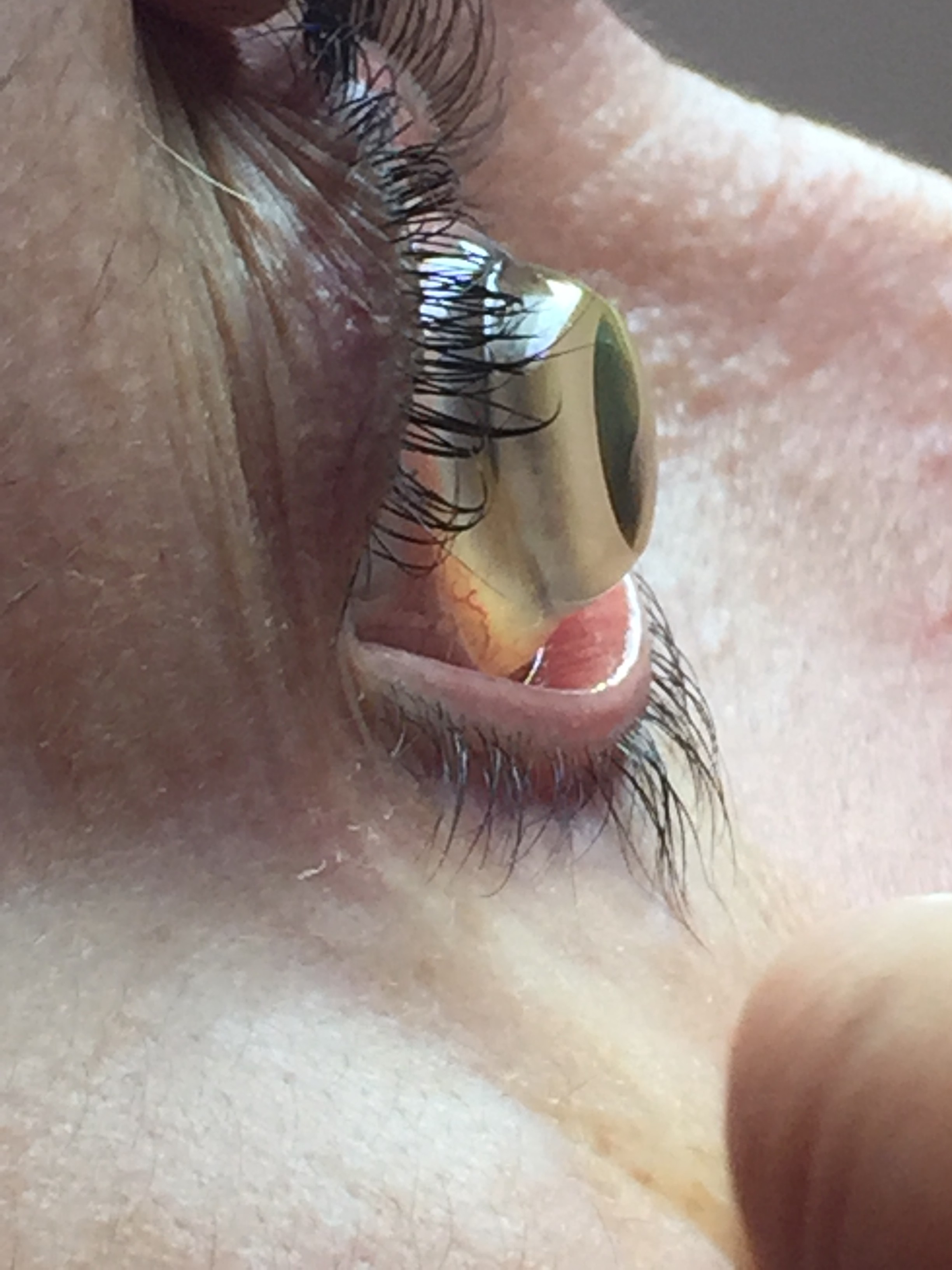 Las lentes de contacto esclerales reducen la necesidad de trasplantes de córnea el queratocono grave - Qvision