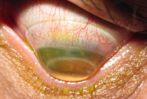scleral qc