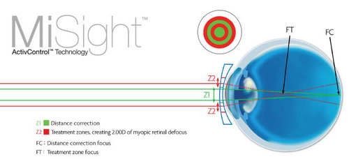 Misight-myopia-control