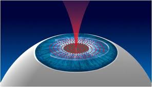 Qvision ¿Cómo funciona el INTRALASE? imagesCA23SWZQ