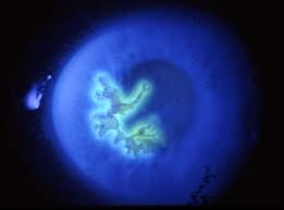 Qvision Queratitis herpética resistente a aciclovir kerattitis