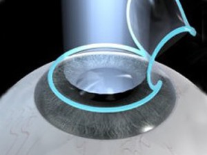 How-is-LASIK-done-300x225