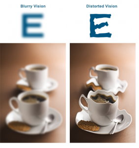 Prevención del Edema Macular Quístico post Cirugía de Cataratas: Revisión Sistemática y Meta-análisis 