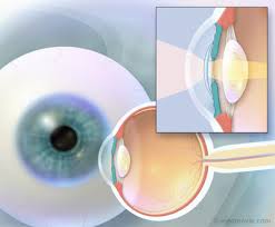 El cálculo de la lente intraocular tras Cirugía Refractiva