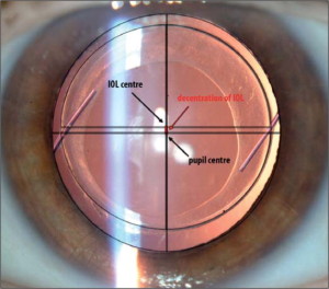Lentes intraoculares monofocales esféricas vs asféricas: comportamiento ante el desalineamiento