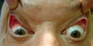 hiperlaxitud palpebral