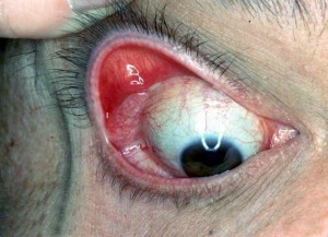 sindrome_del_parpado_flacido_h