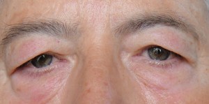 dermatocalasia